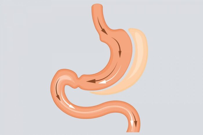 How Safe And Effective Is Bariatric Surgery?