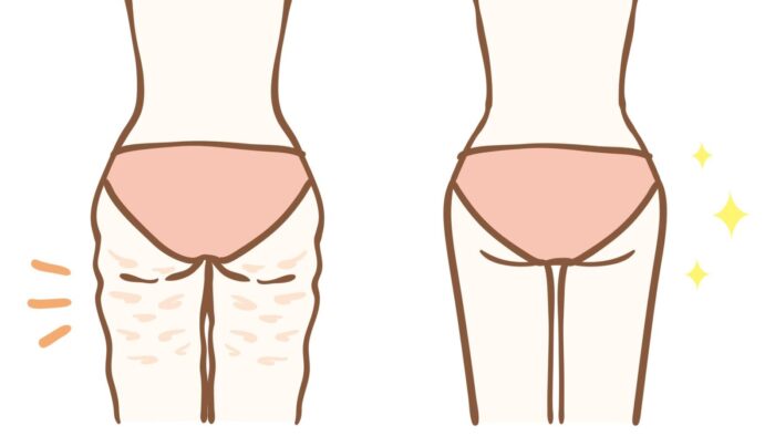 Do Creams Actually Work For Cellulite LISS Cardio Low Intensity do-creams-actually-work-for-cellulite-liss-cardio-low-intensity